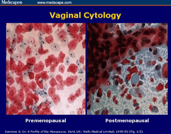 Atrophic Vaginitis And Estrogen Treatment 