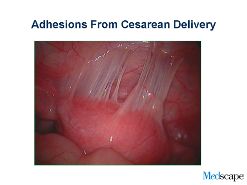 Adhesions from cesarean delivery (photo). (Enlarge Slide)