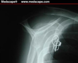 cerclage procedure video