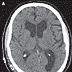 Idiopathic Normal Pressure Hydrocephalus: Clinical Presentation ... Idiopathic Normal Pressure Hydrocephalus: Clinical Presentation ...