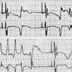 nonischemic cardiomyopathy