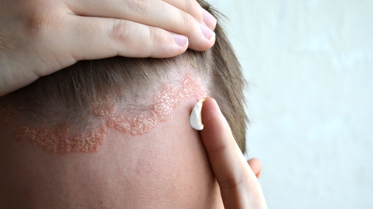 Topical Psoriasis Treatments For Long Term Management From Data To Practice