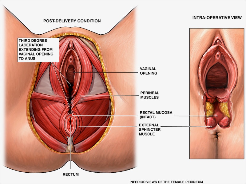 Vaginal Tearing After Sex 2