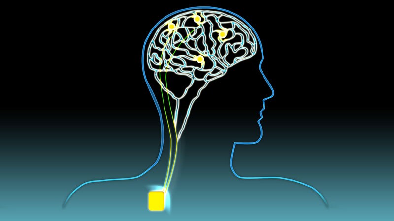 General or Local Anesthesia for DBS Surgery: Which Is Best? - newspostwall General or Local Anesthesia for DBS Surgery: Which Is Best?