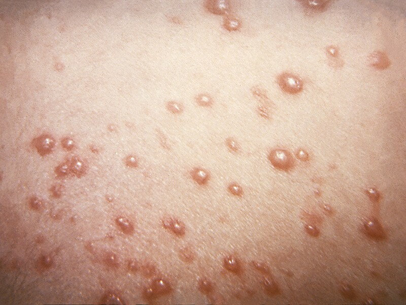 Adult Shingles 97