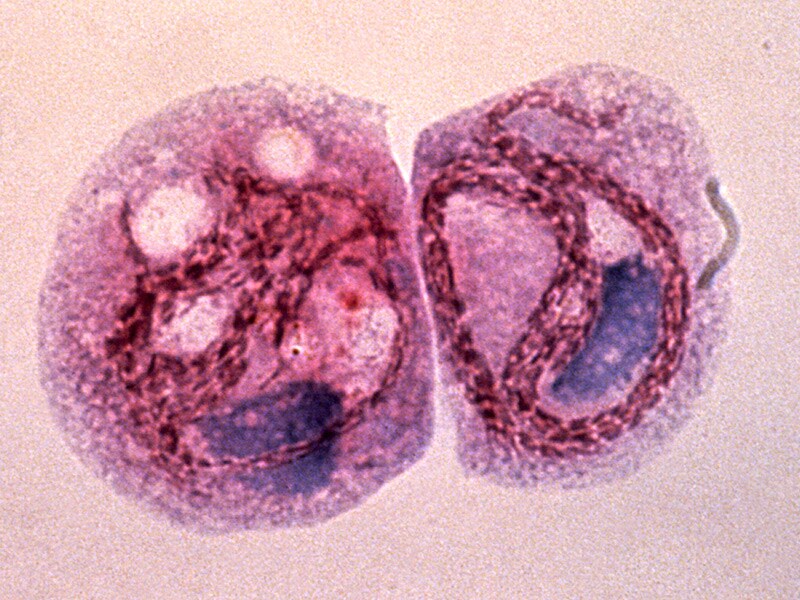 Legionellosis Incidence Increases; Better Diagnostics Needed