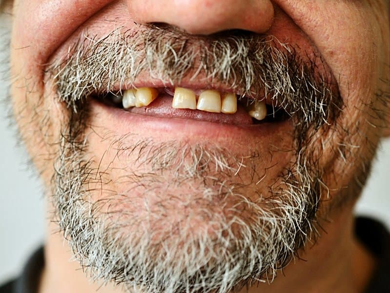 tooth loss tied to cv risk markers in global chd cohort