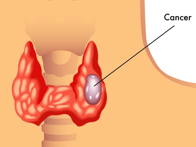 Image result for thyroid cancer