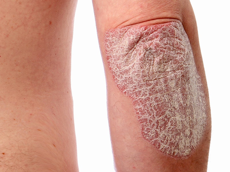 Psoriasis Pictures, Images & Photos | Photobucket