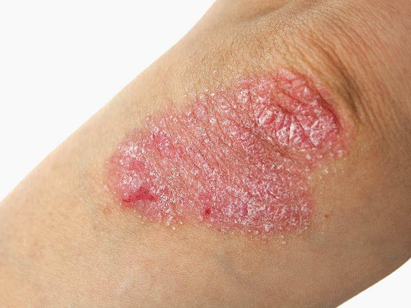 Slide show: Types of psoriasis (psoriasis pictures) - Mayo ...