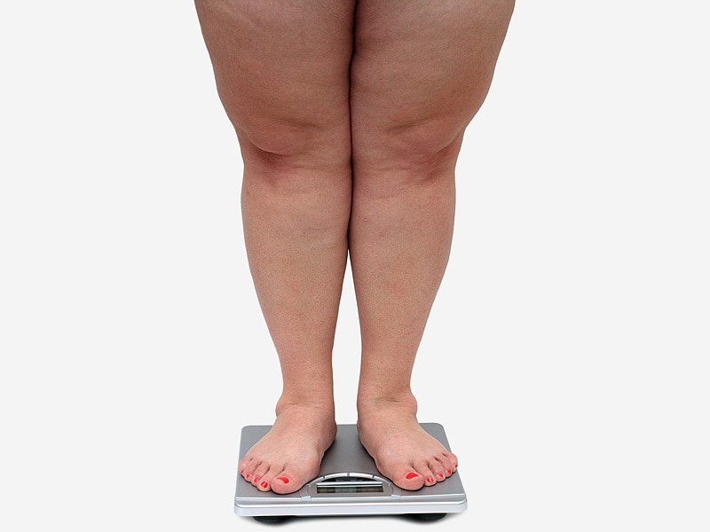 Image result for obesity oa