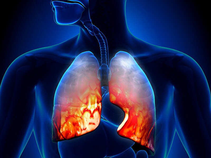 Pneumonia Treatment Failure Rates High