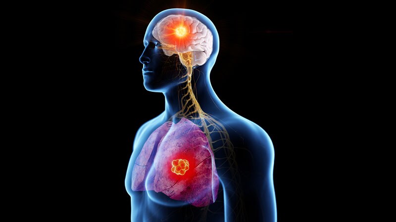 Improved Survival in Patients With NSCLC and Brain Metastases 1 Improved Survival in Patients With NSCLC and Brain Metastases