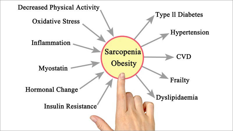 La Sarcopenia Acorta La Supervivencia De Las Personas Con Diabetes Tipo