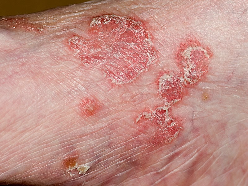Psoriasis of the Penis (Prevention and Treatment)