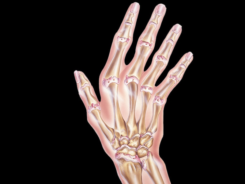First Enbrel Biosimilar Recommended for Approval in Europe First Enbrel Biosimilar Recommended for Approval in Europe