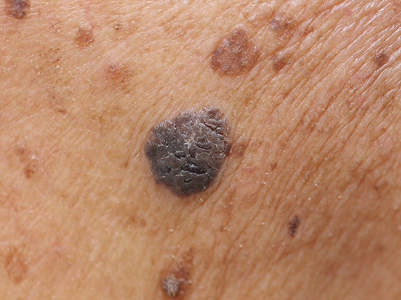 pembrolizumab-now-approved-for-first-line-in-melanoma