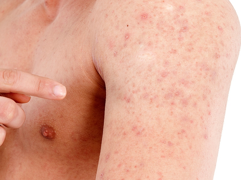 Resultado de imagen para Psoriasis, Eczema y Acné.