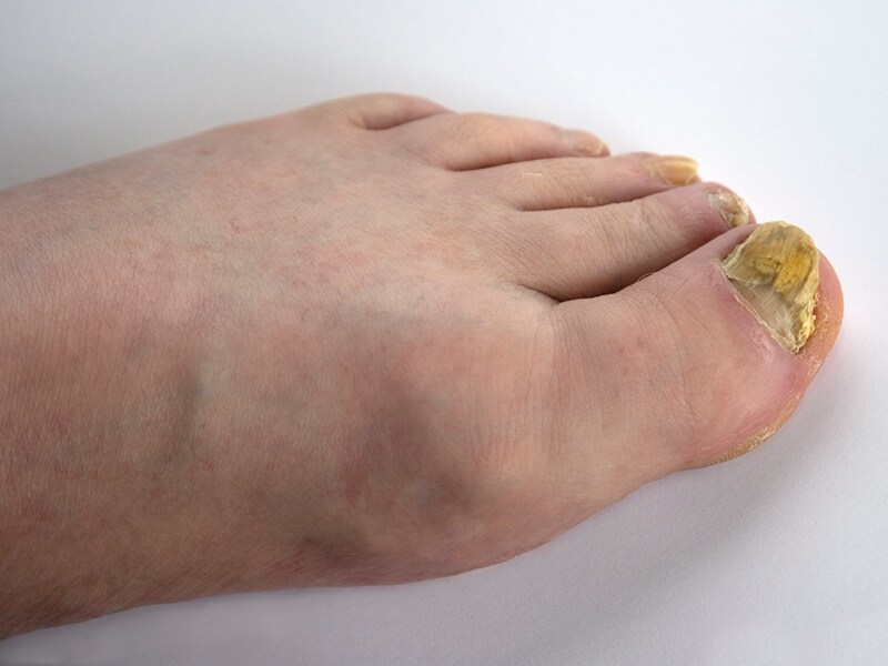 toenail fungus lamisil treatment