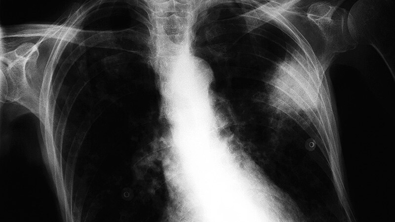 Screening Could Reduce Lung Cancer Deaths by Quarter - newspostwall Screening Could Reduce Lung Cancer Deaths by Quarter