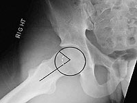Hip displacement in teens very grateful Hip displacement in teens