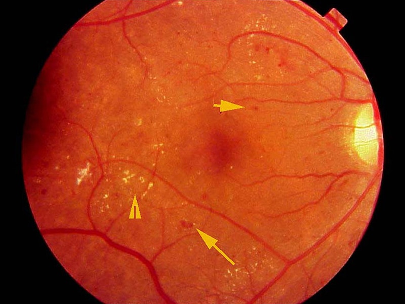 Diabetic Macular Edema Eylea Photobiomodulation In Diabetic Macular