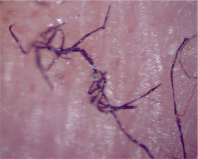 Shocking Morgellons Disease Actual Pictures