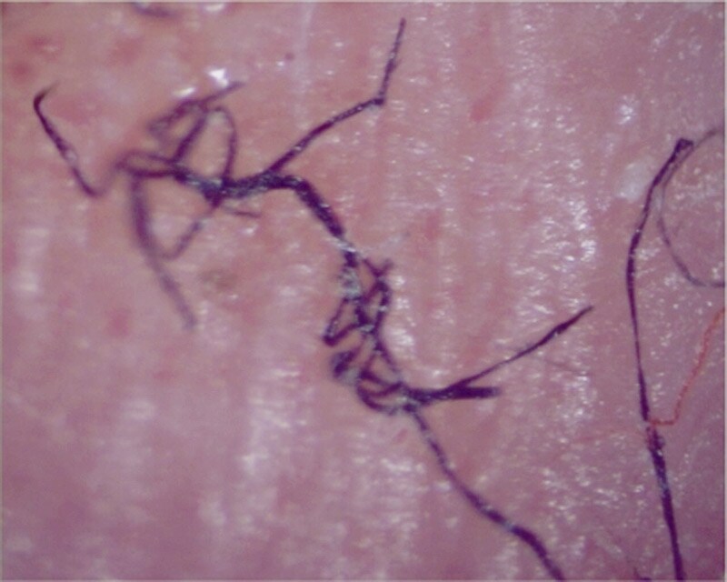 morgellons pictures