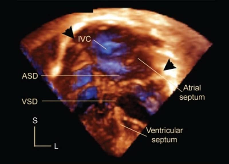 Left Atrial Size Using 3D Echocardiography in AF Patients