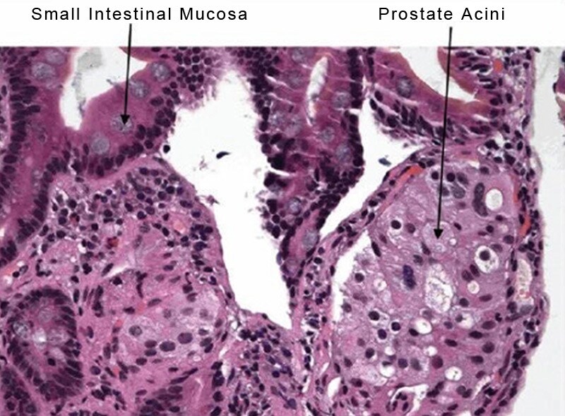 surgical-castration-instead-of-drugs-in-prostate-cancer