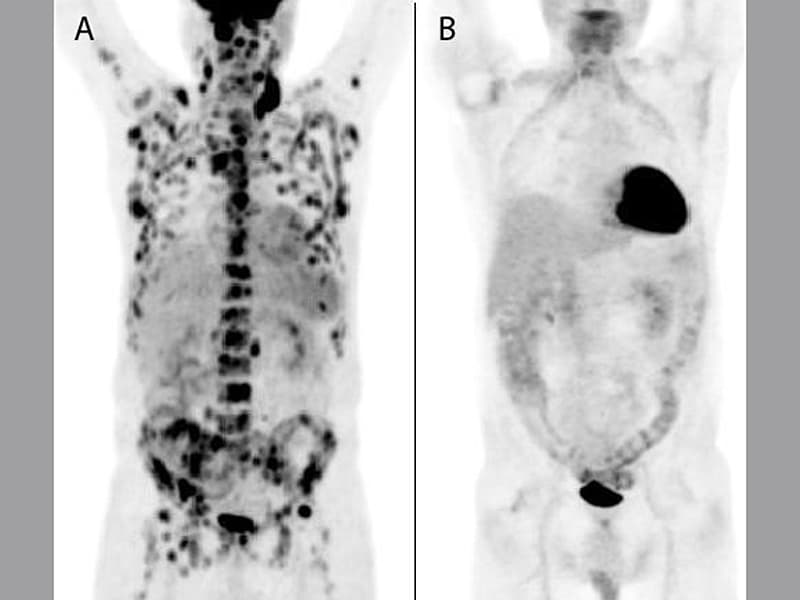 Hodgkin S Lymphoma Pet Scan Results