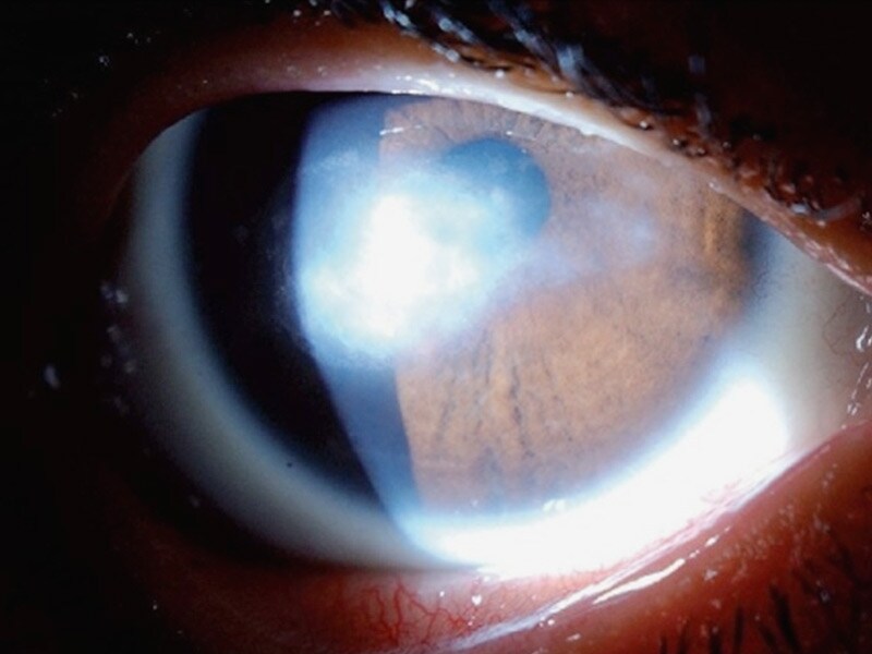 Chmp Backs Cenegermin Oxervate For Neurotrophic Keratitis