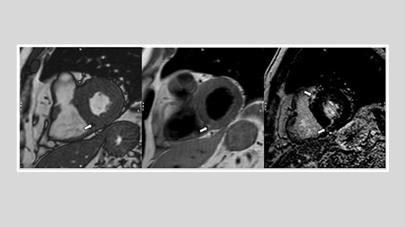 New Approach to Heart Failure Targets Myocardial Fibrosis 1 New Approach to Heart Failure Targets Myocardial Fibrosis