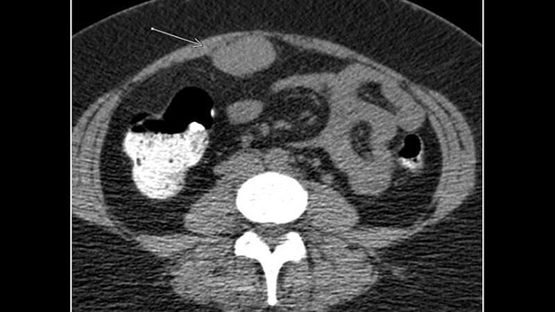 Socioeconomic Disparities Persist in Hysterectomy Access - newspostwall Socioeconomic Disparities Persist in Hysterectomy Access