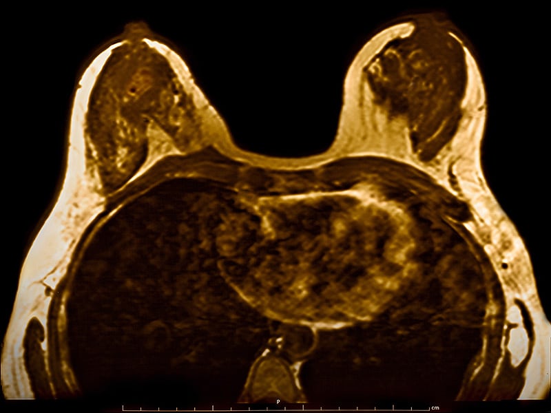 mri-blog-breast-mri