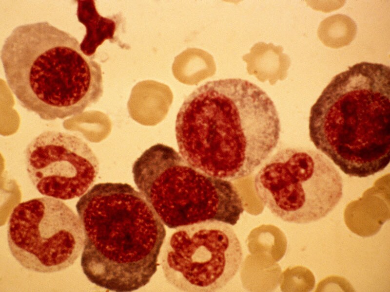 Anaphylaxis Risk Highest With IV Iron Dextran