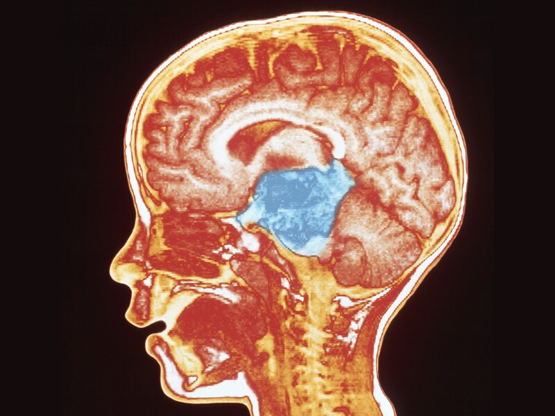 Low Grade Glioma In Child Symptoms