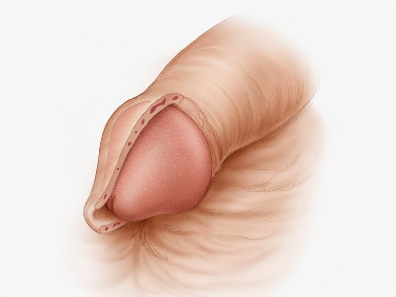 Circumcise Penis 97