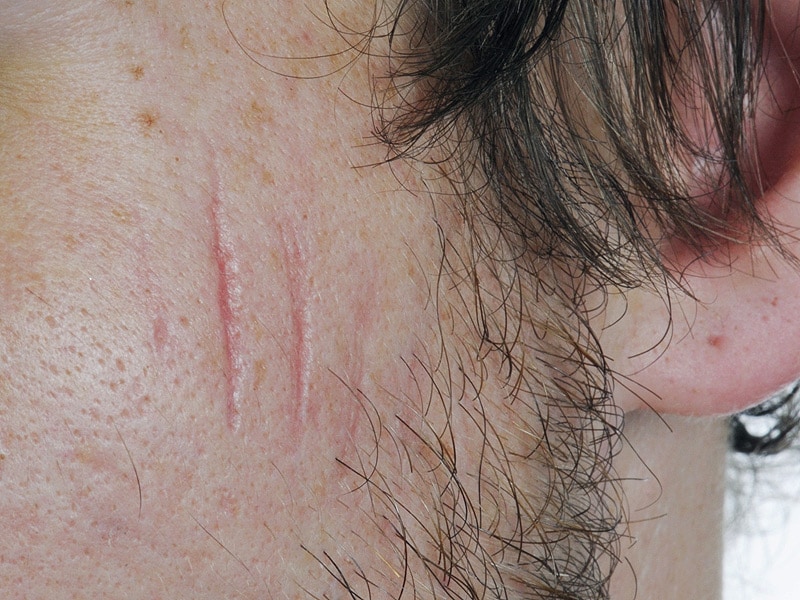 Linear Facial Scars More Aesthetically Pleasing Than Zigzag Scars