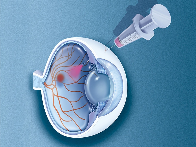 New Anti VEGF Drug Promising For Wet Macular Degeneration