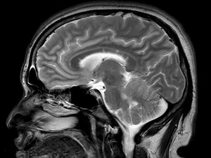 MRI Guidelines in MS Updated