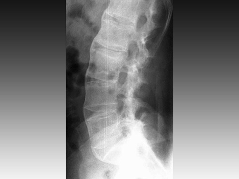 ankylosing-spondylitis-radrounds-radiology-network