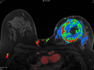 Fast MRI Improves Breast Cancer Screening