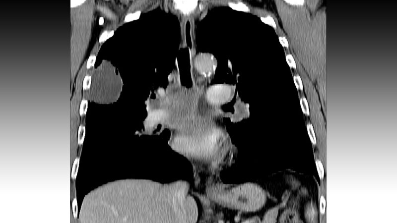 ATLANTIS Results: Lurbinectedin Plus Doxorubicin in SCLC 1 ATLANTIS Results: Lurbinectedin Plus Doxorubicin in SCLC