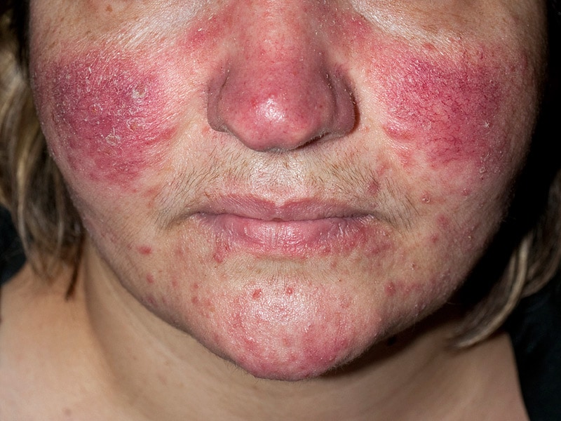 rosacea photos