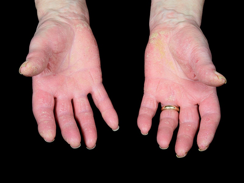 Ixekizumab Effective in Phase 3 Psoriatic Arthritis Trial