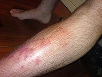 Recurrent Cellulitis: Robust Information From an RCT