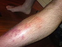 ... Cellulitis Misdiagnoses Prophylactic Antibiotics for Cellulitis of the