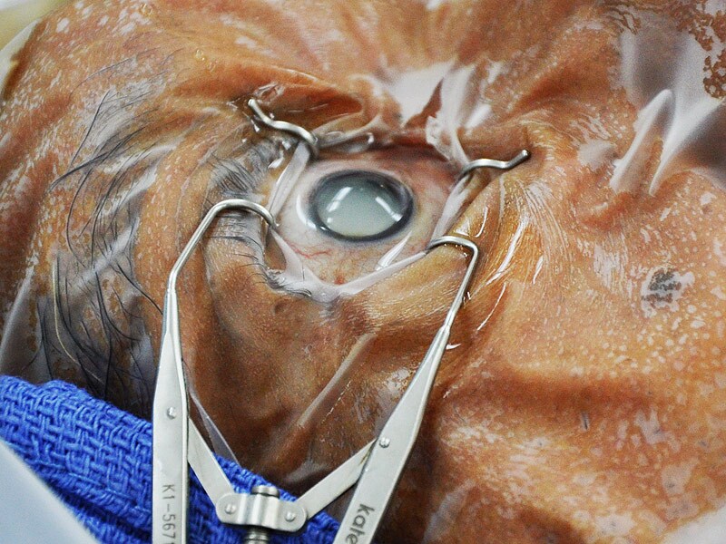 cataract surgery after cataract surgery images cataract surgery after cataract surgery images
