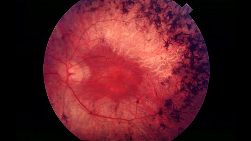 Gene Therapy Research Accelerates for Retinal Diseases 1 Gene Therapy Research Accelerates for Retinal Diseases